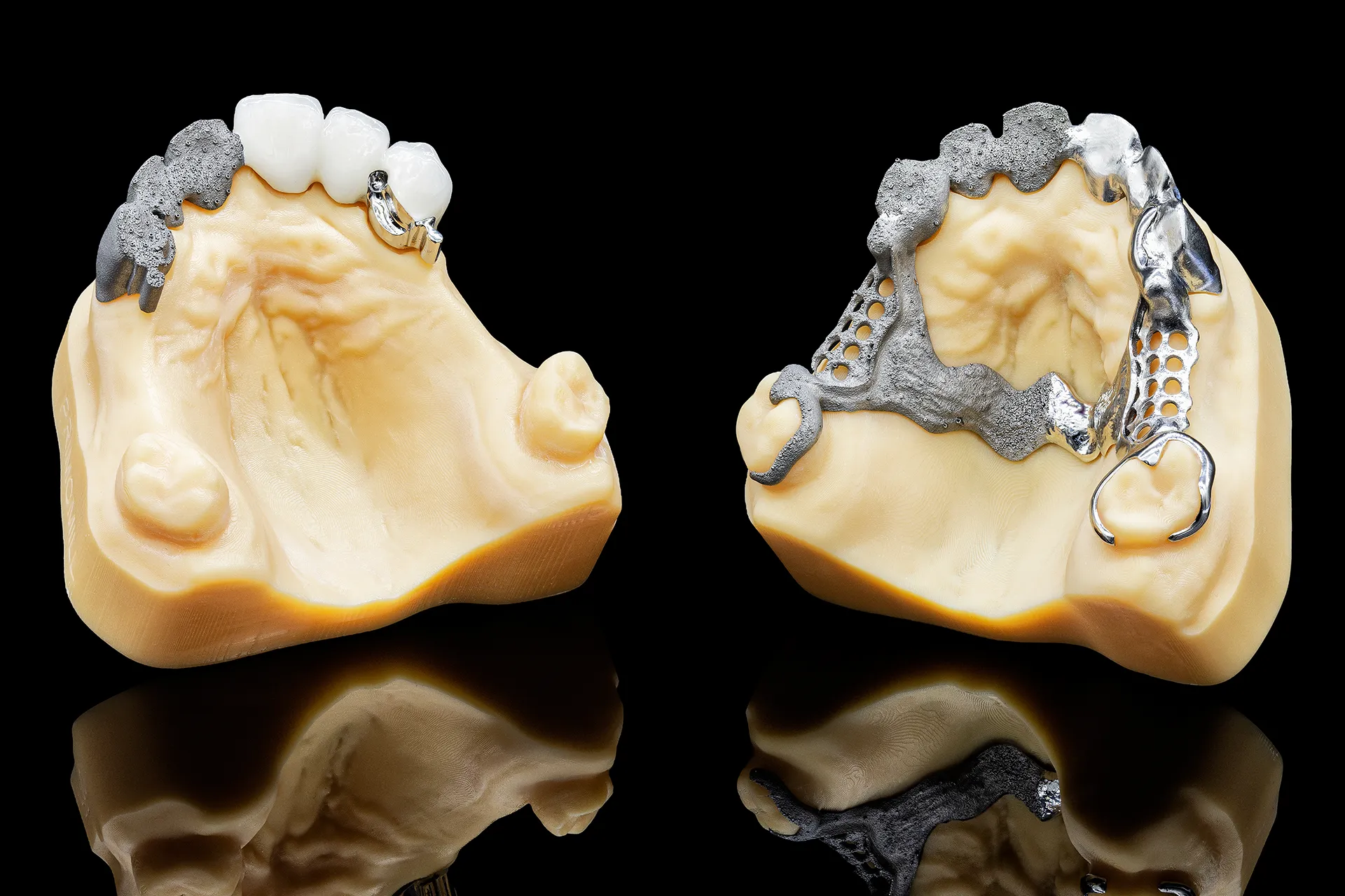 Slm dentures 2